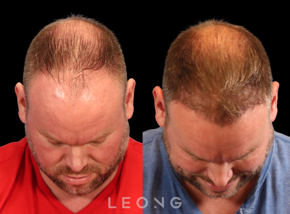 Hair Transplant Before & After Gallery - Patient 358755 - Image 4