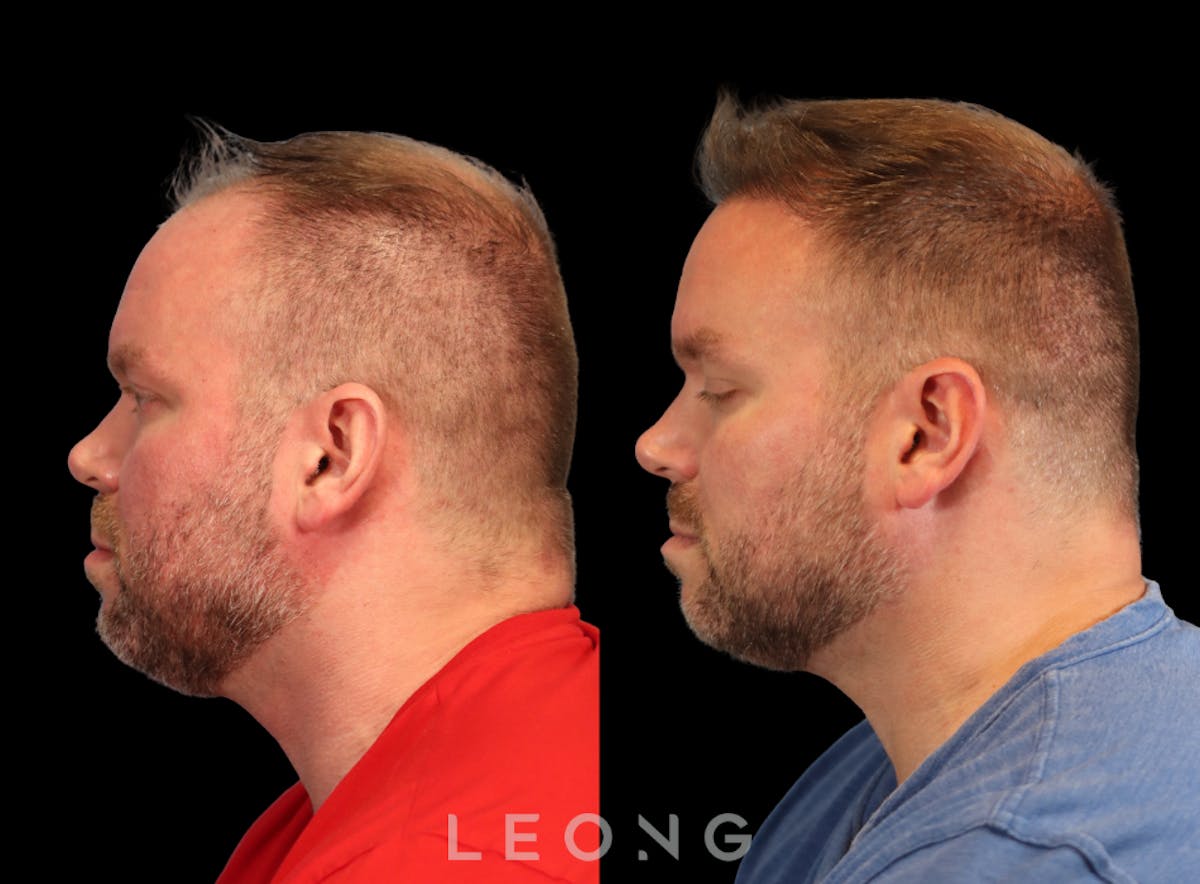 Hair Transplant Before & After Gallery - Patient 358755 - Image 3