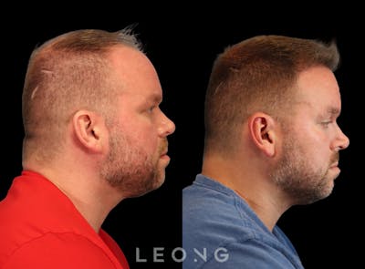 Hair Transplant Before & After Gallery - Patient 358755 - Image 1