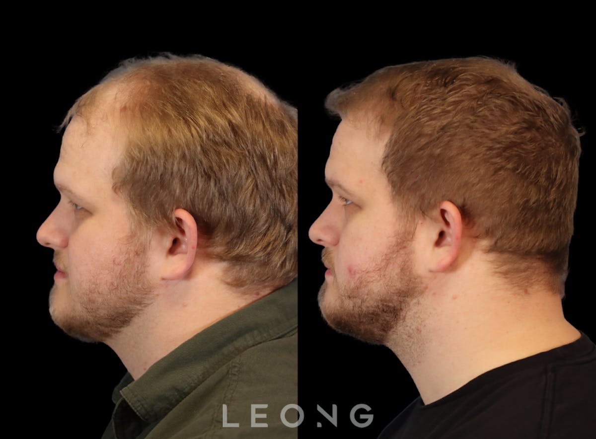 Hair Transplant Before & After Gallery - Patient 297398 - Image 6