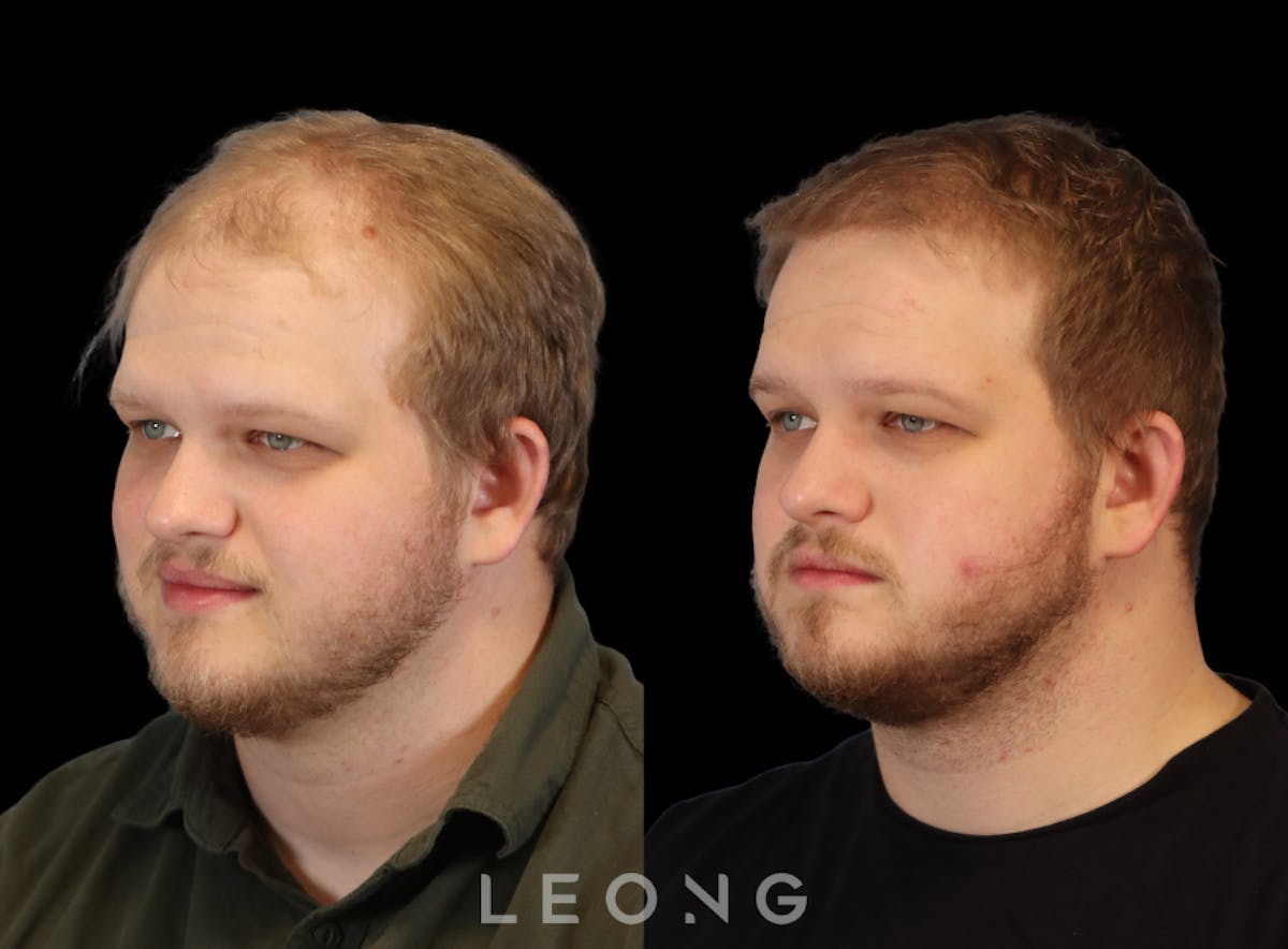 Hair Transplant Before & After Gallery - Patient 297398 - Image 5
