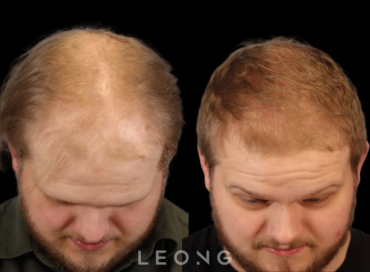 Hair Transplant Before & After Gallery - Patient 297398 - Image 2