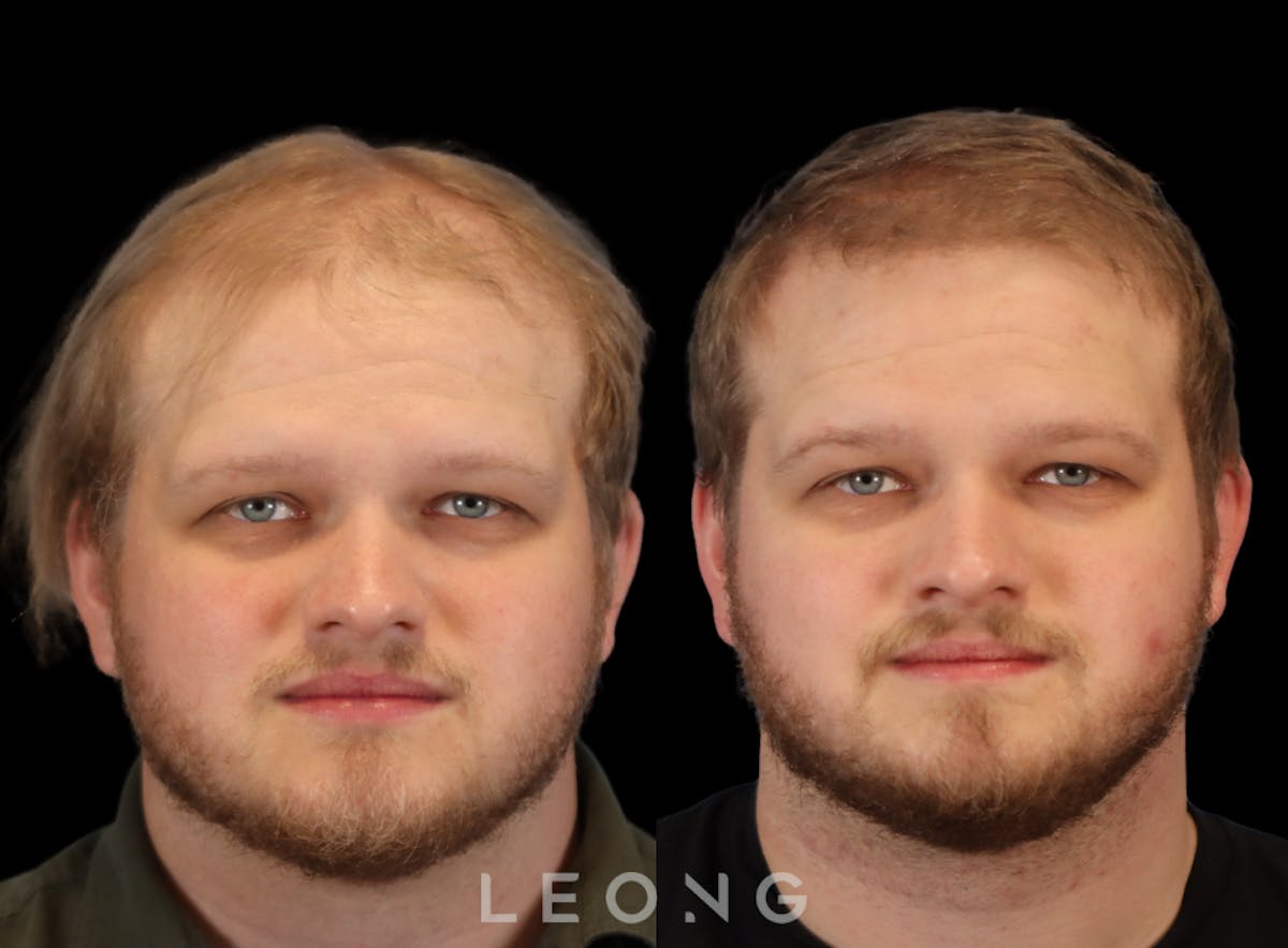 Hair Transplant Before & After Gallery - Patient 297398 - Image 1