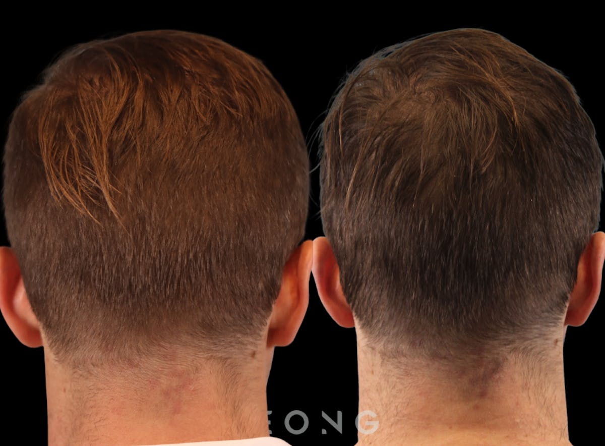 Hair Transplant Before & After Gallery - Patient 262576 - Image 7