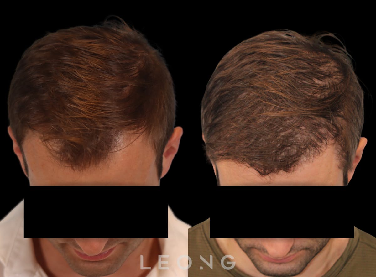 Hair Transplant Before & After Gallery - Patient 262576 - Image 6