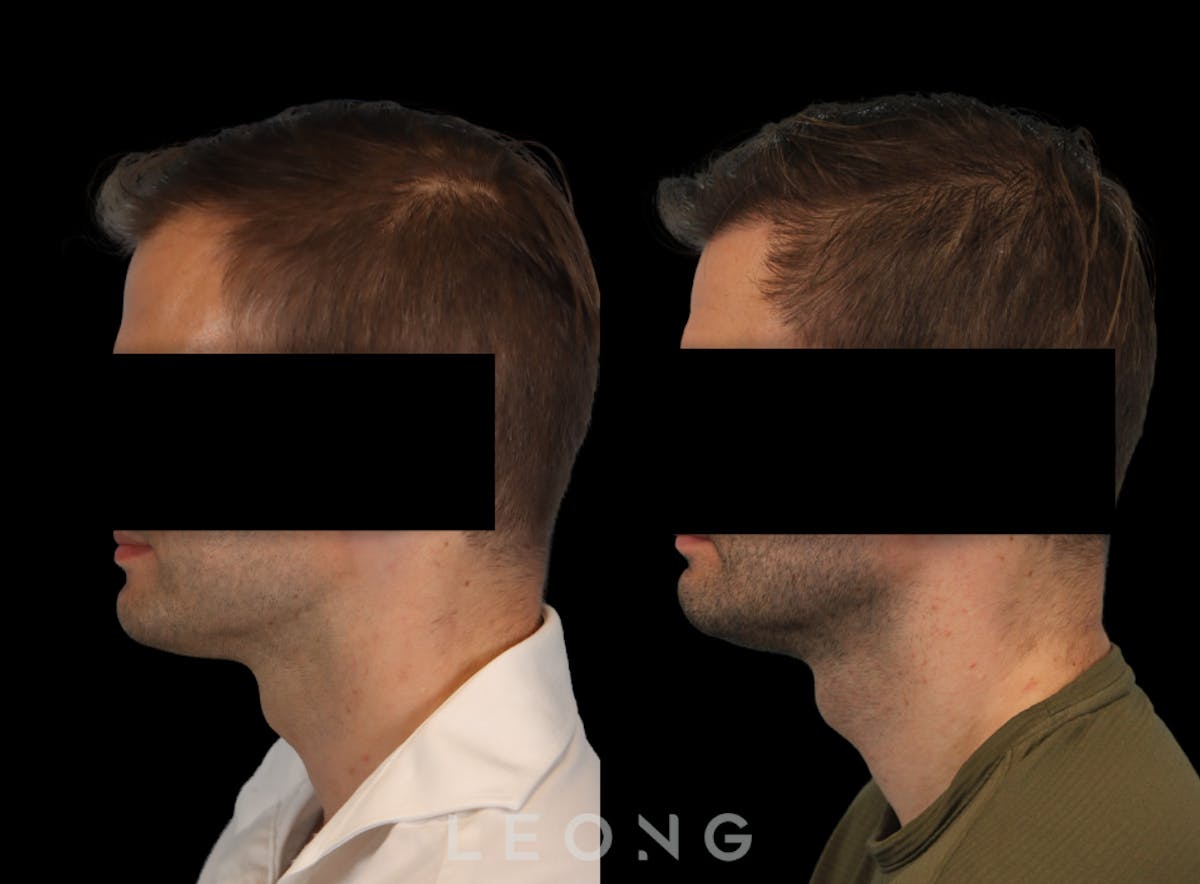 Hair Transplant Before & After Gallery - Patient 262576 - Image 5