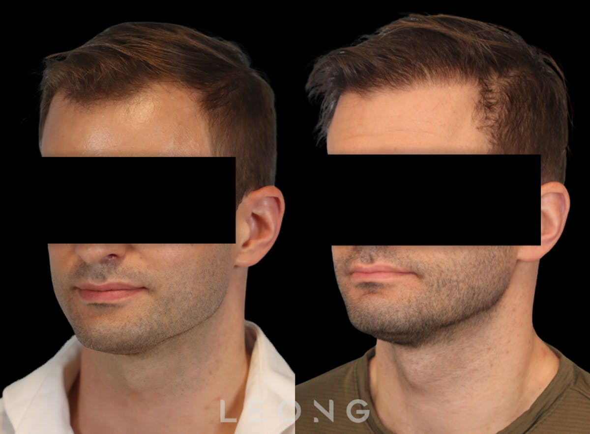 Hair Transplant Before & After Gallery - Patient 262576 - Image 4