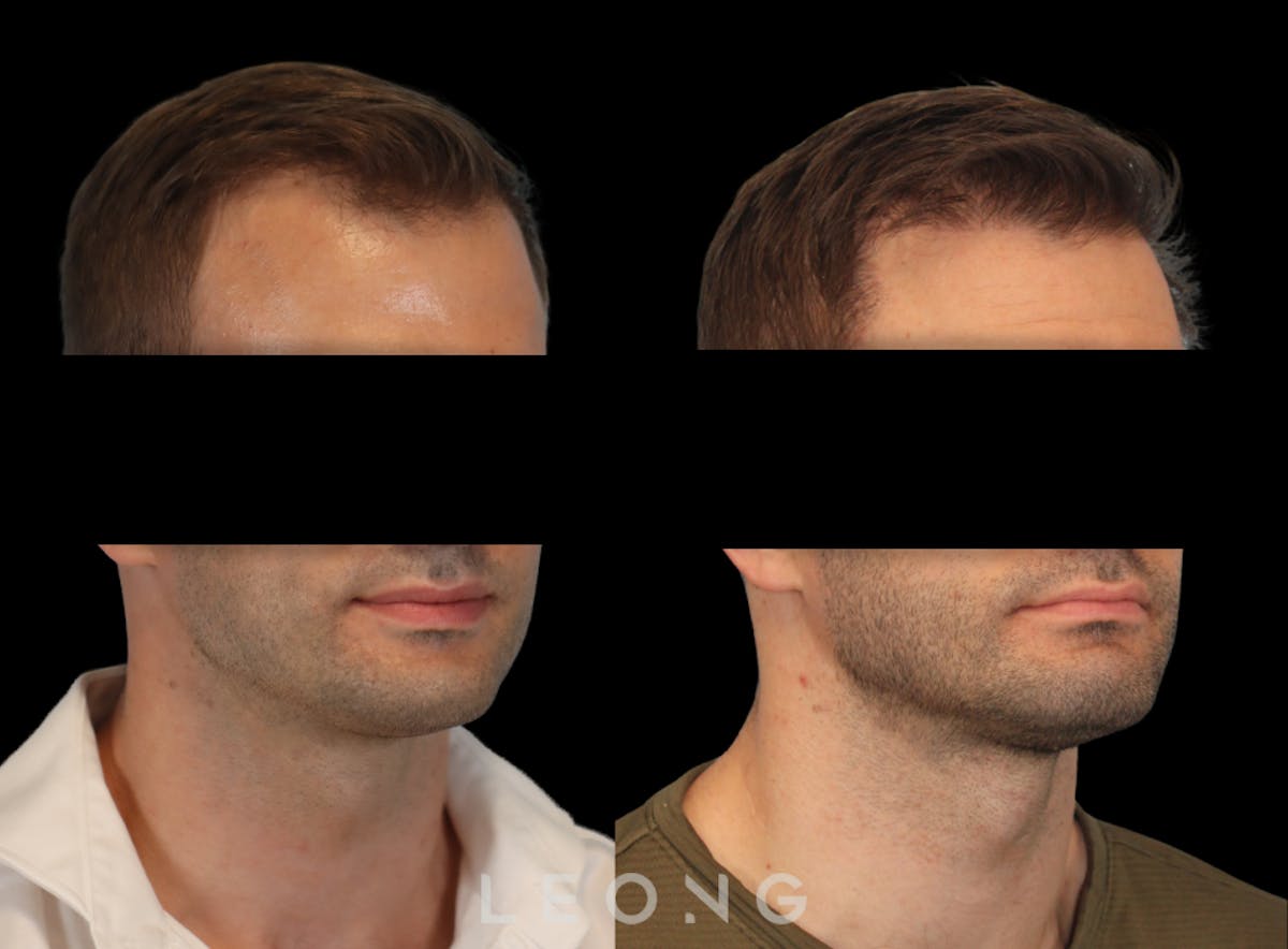 Hair Transplant Before & After Gallery - Patient 262576 - Image 2