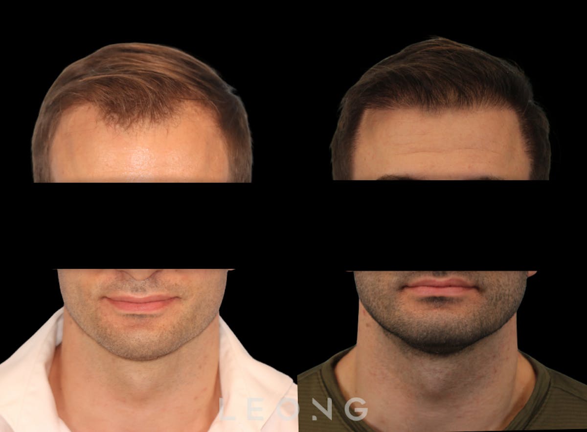 Hair Transplant Before & After Gallery - Patient 262576 - Image 1