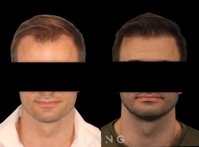 Hair Transplant Before & After Gallery - Patient 262576 - Image 1