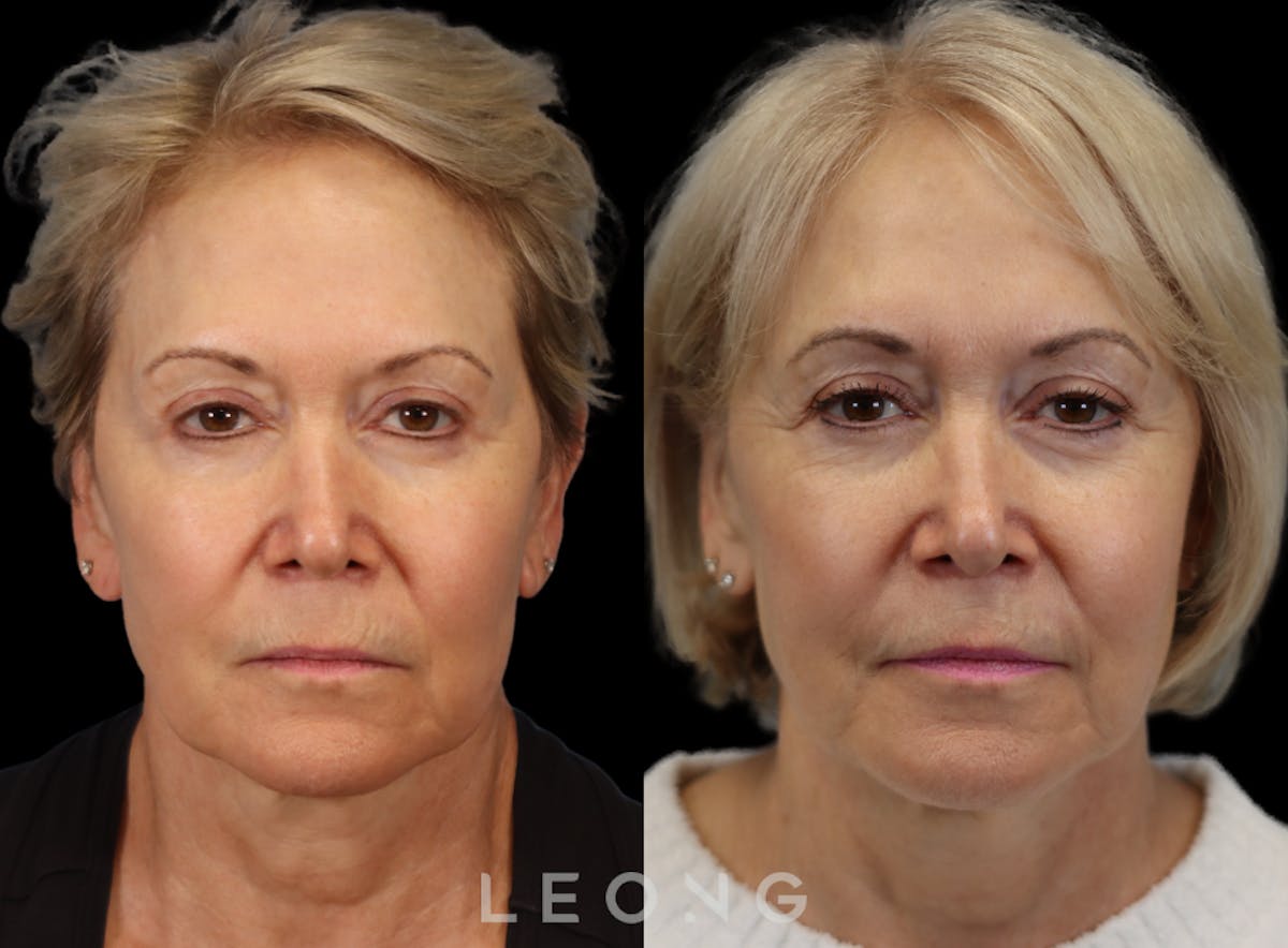 Hair Transplant Before & After Gallery - Patient 293900 - Image 1