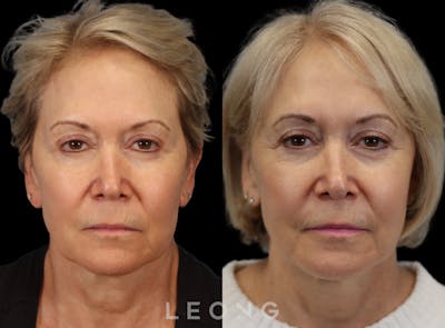 Hair Transplant Before & After Gallery - Patient 293900 - Image 1