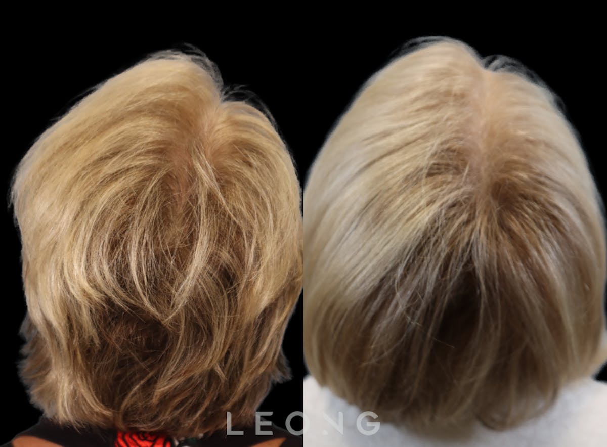 Hair Transplant Before & After Gallery - Patient 293900 - Image 7