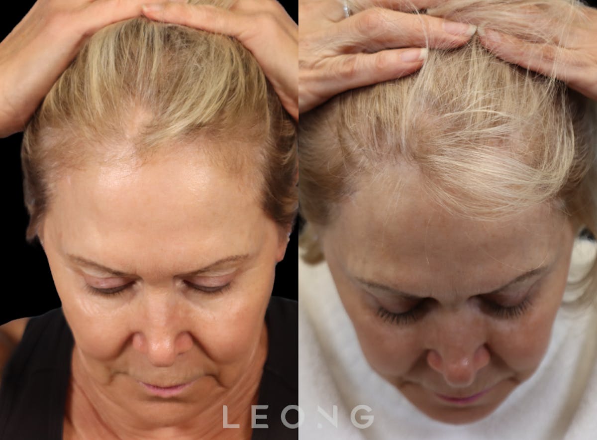 Hair Transplant Before & After Gallery - Patient 293900 - Image 8