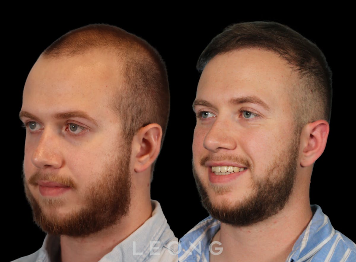 Hair Transplant Before & After Gallery - Patient 315110 - Image 2