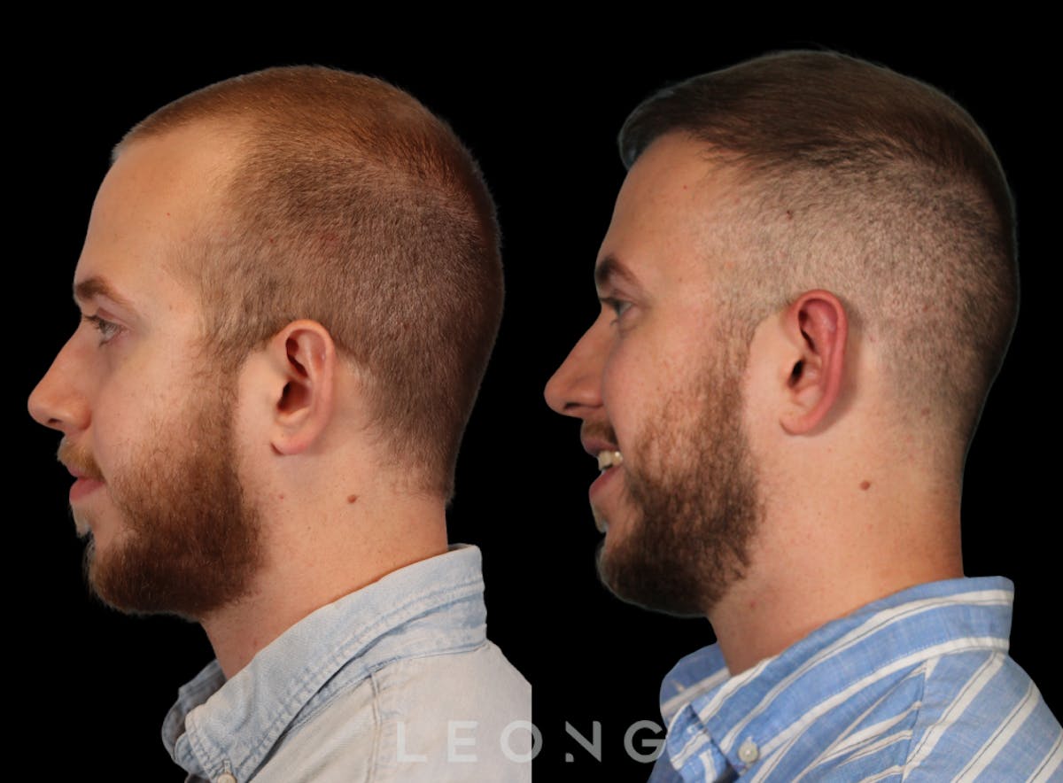 Hair Transplant Before & After Gallery - Patient 315110 - Image 4