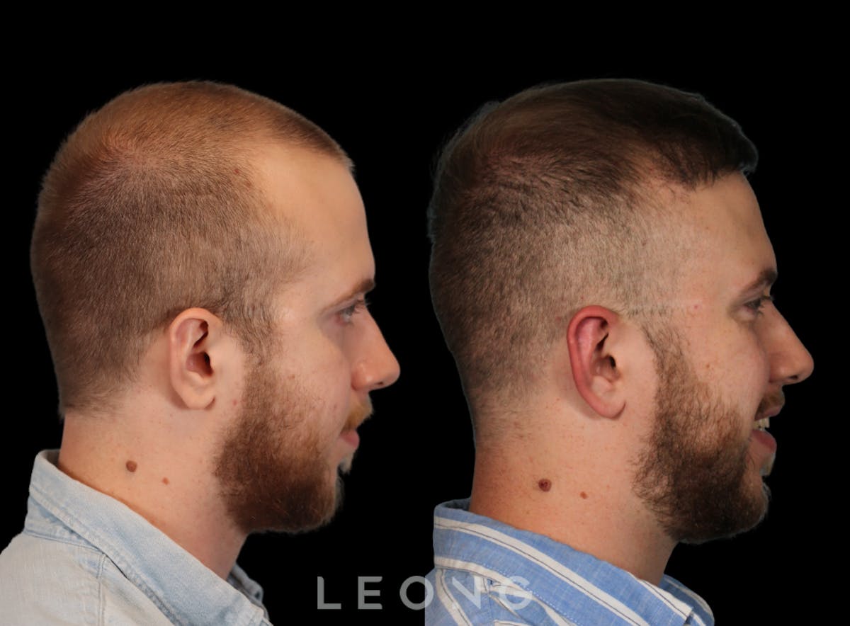 Hair Transplant Before & After Gallery - Patient 315110 - Image 3