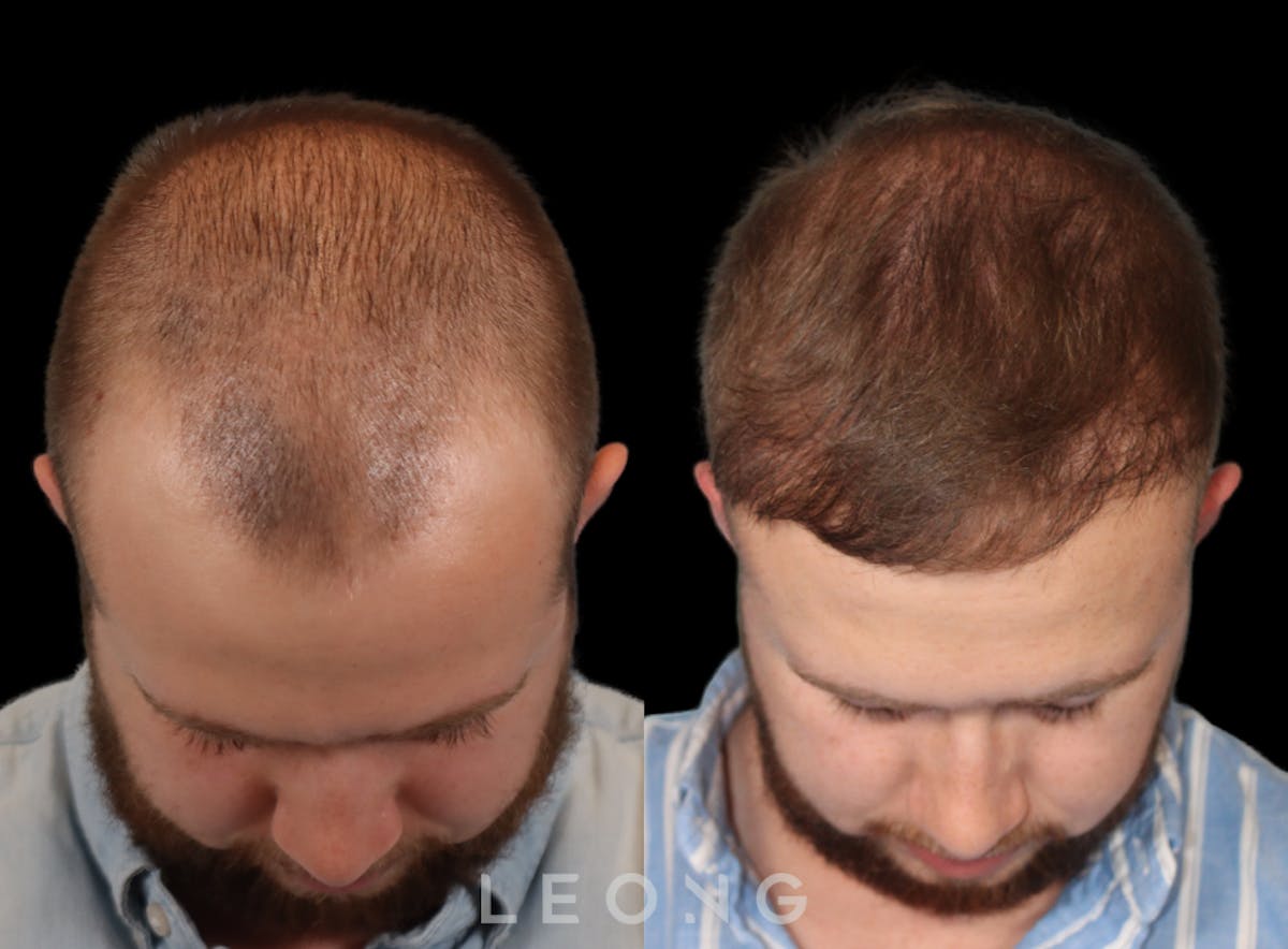 Hair Transplant Before & After Gallery - Patient 315110 - Image 5