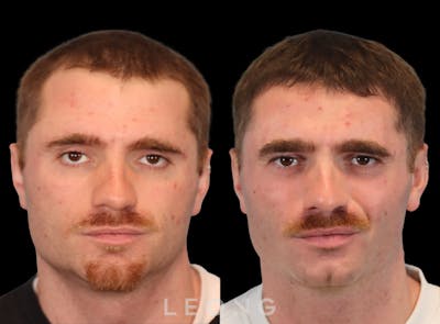 Hair Transplant Before & After Gallery - Patient 289044 - Image 1
