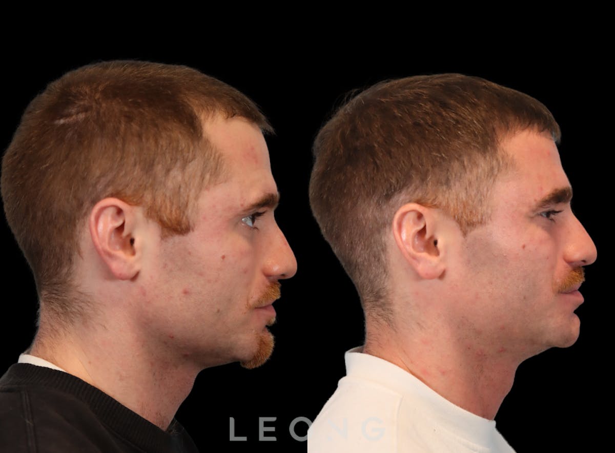 Hair Transplant Before & After Gallery - Patient 289044 - Image 2