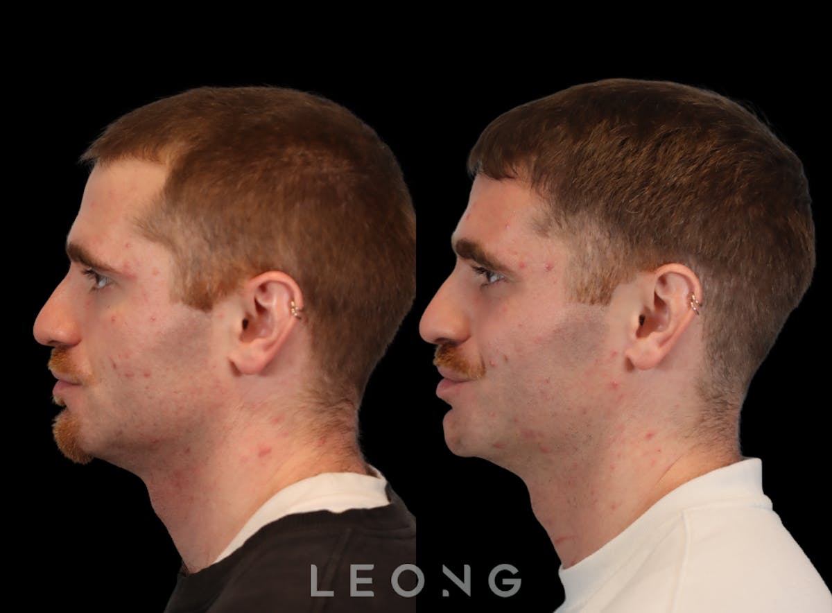 Hair Transplant Before & After Gallery - Patient 289044 - Image 3