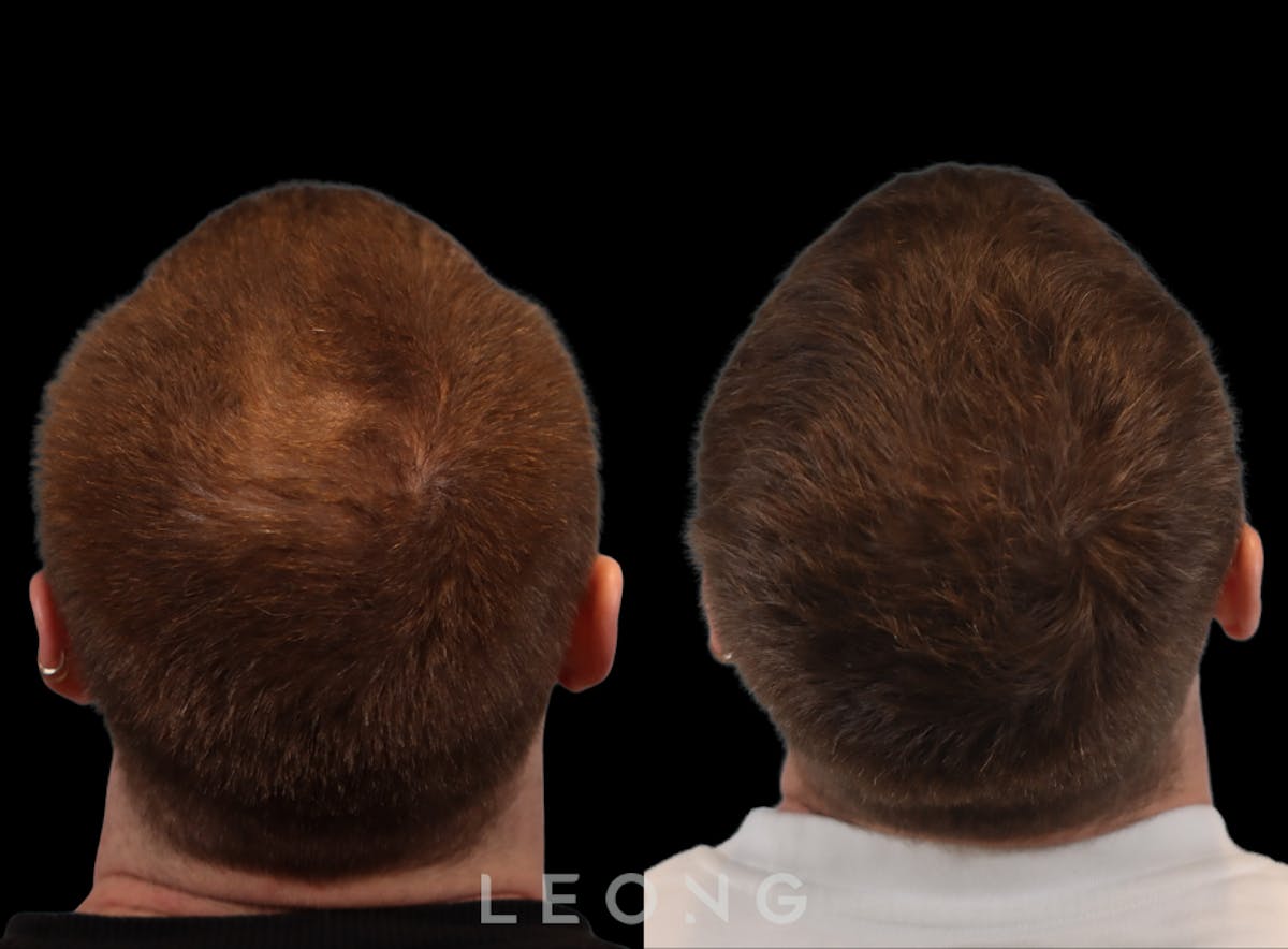 Hair Transplant Before & After Gallery - Patient 289044 - Image 5