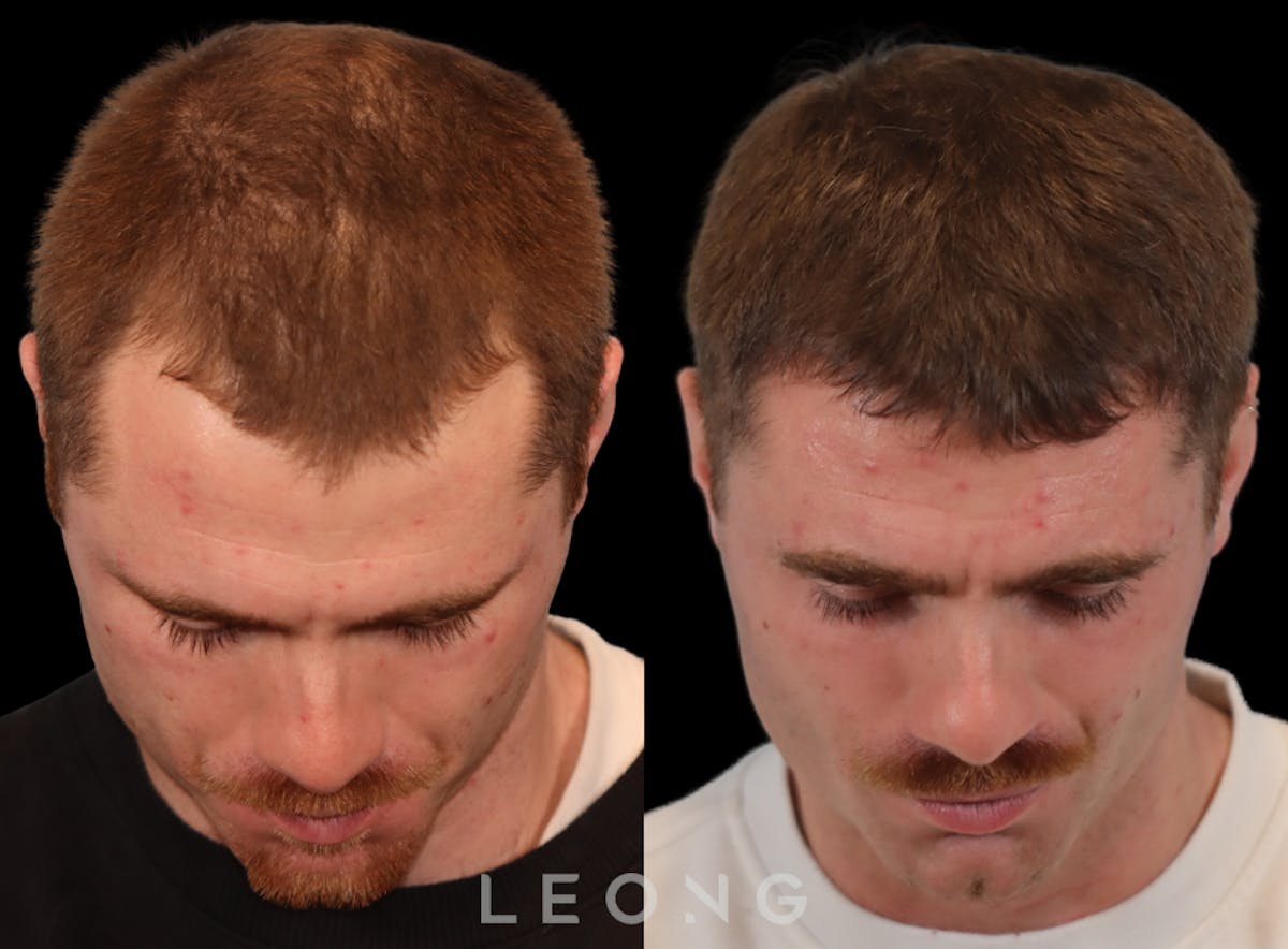 Hair Transplant Before & After Gallery - Patient 289044 - Image 6