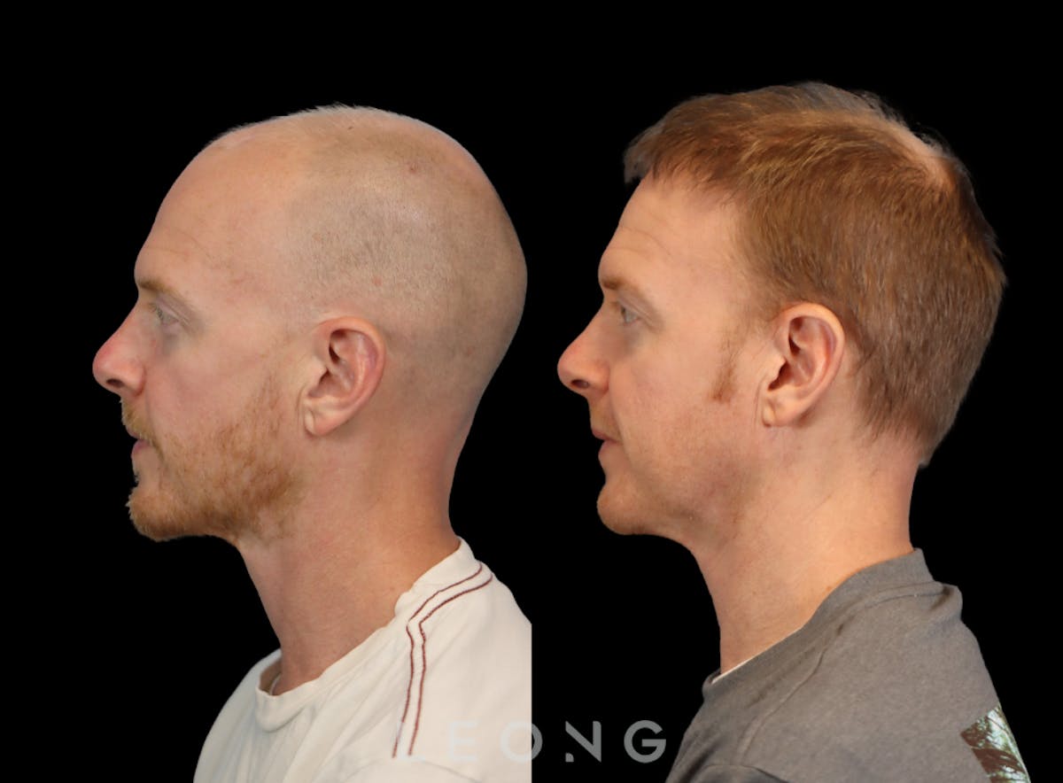Hair Transplant Before & After Gallery - Patient 334614 - Image 5