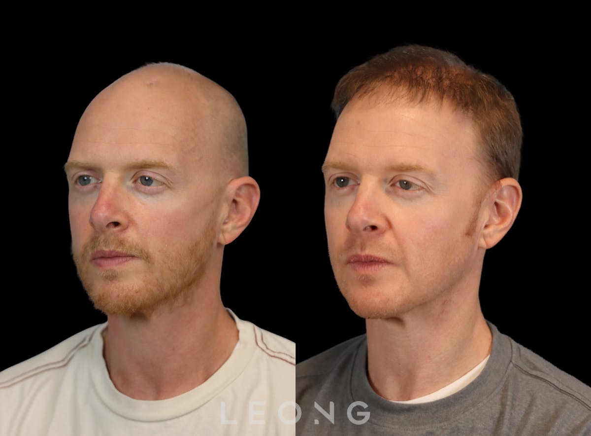 Hair Transplant Before & After Gallery - Patient 334614 - Image 4