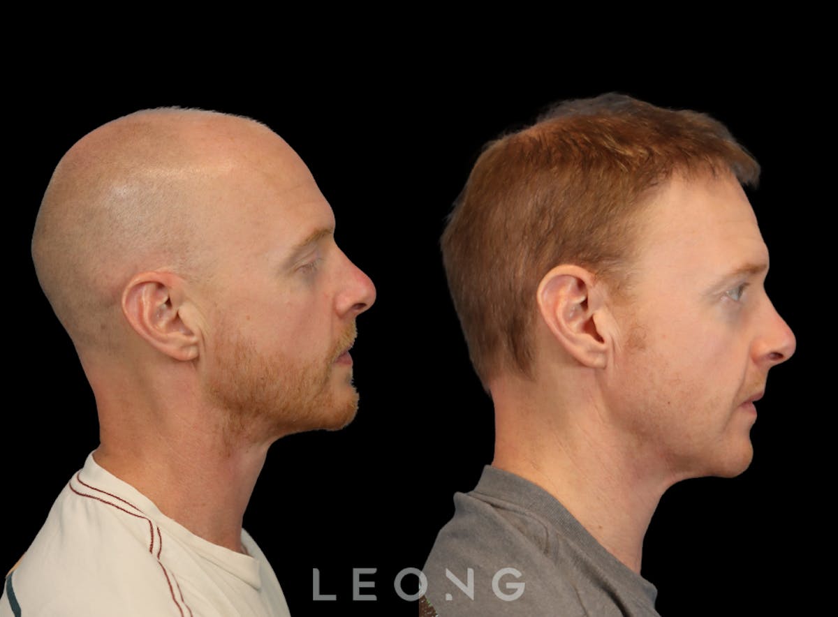 Hair Transplant Before & After Gallery - Patient 334614 - Image 3