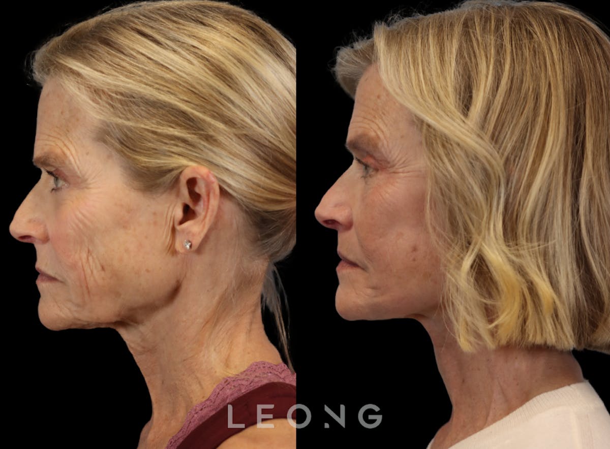 Facelift Before & After Gallery - Patient 376596 - Image 5