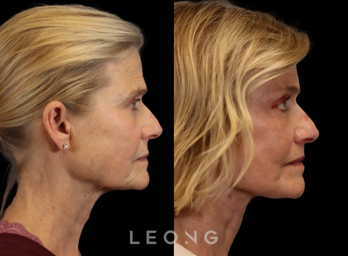 Facelift Before & After Gallery - Patient 376596 - Image 4