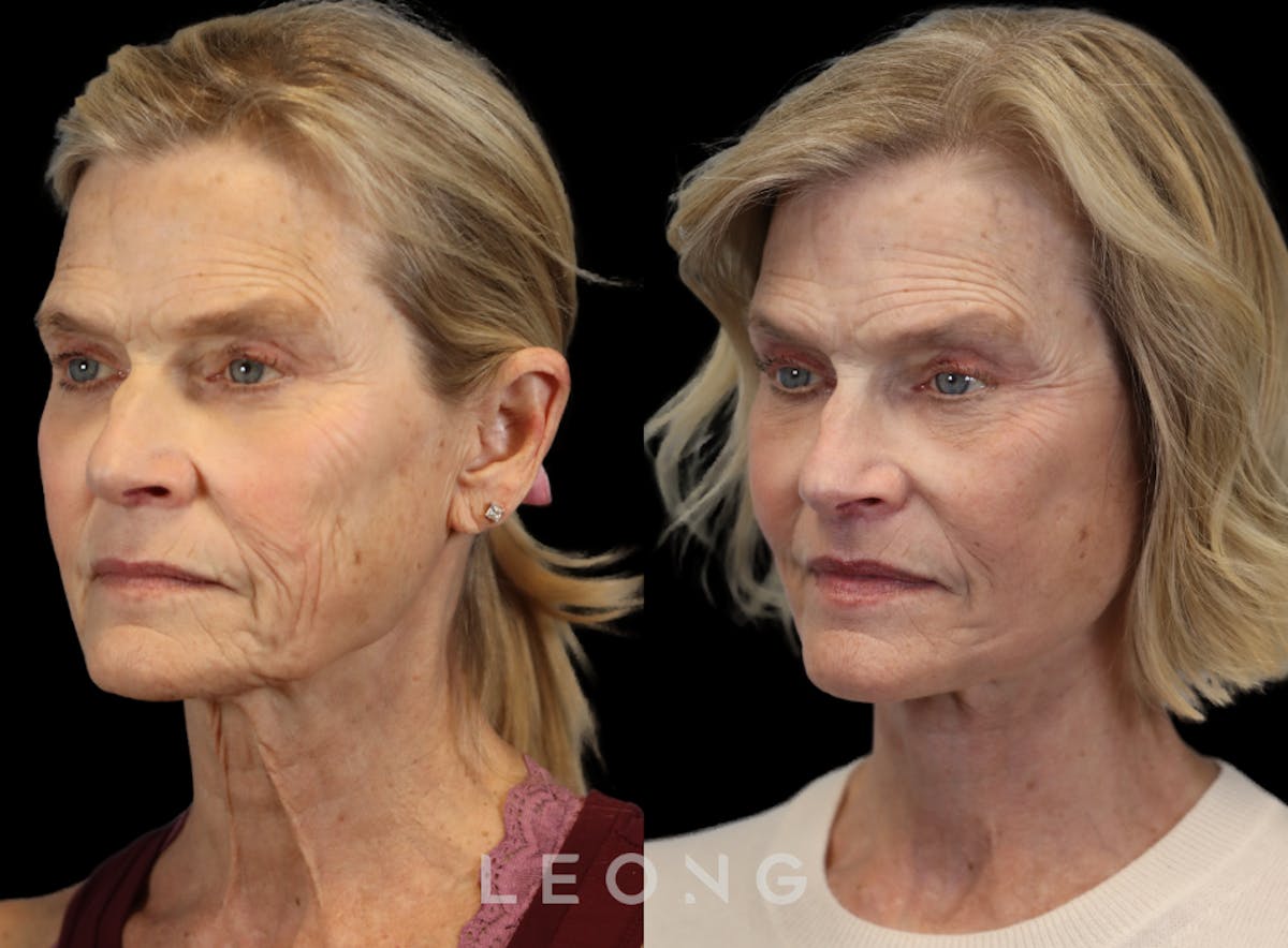 Facelift Before & After Gallery - Patient 376596 - Image 2