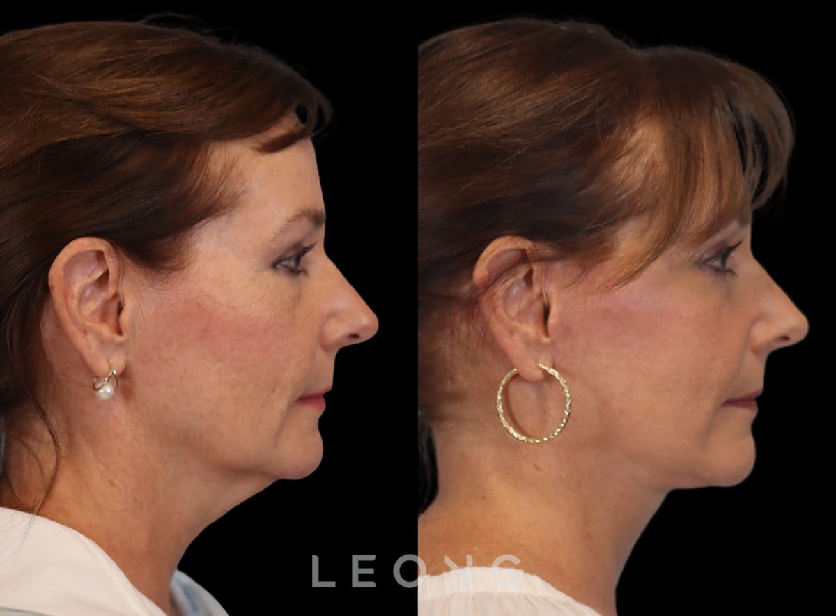 Facelift Before & After Gallery - Patient 767837 - Image 4