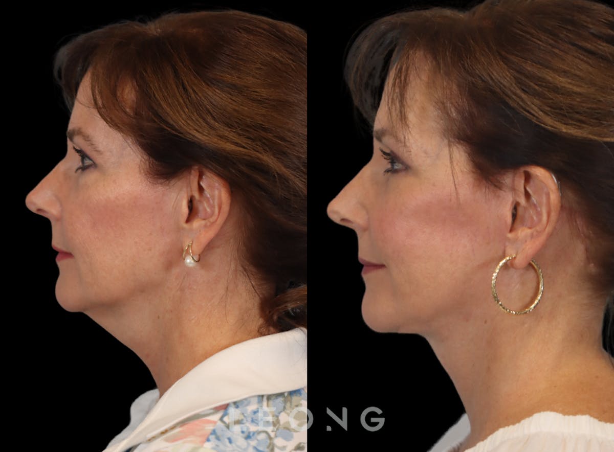 Facelift Before & After Gallery - Patient 767837 - Image 5