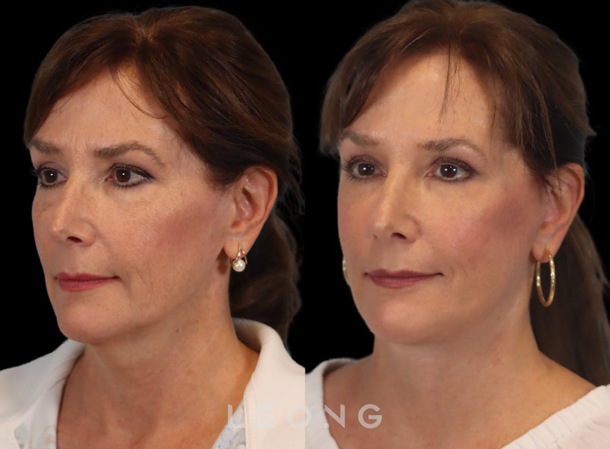 Facelift Before & After Gallery - Patient 767837 - Image 7