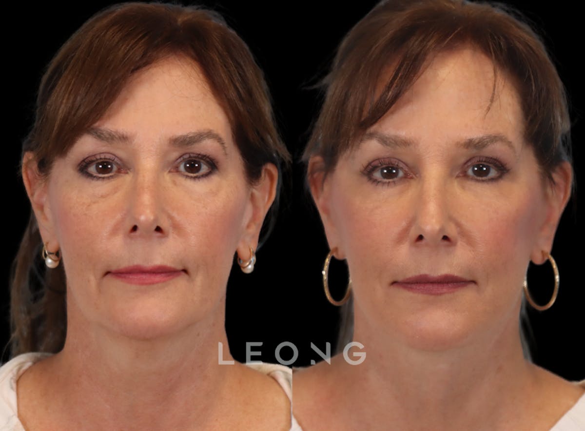 Facelift Before & After Gallery - Patient 767837 - Image 1