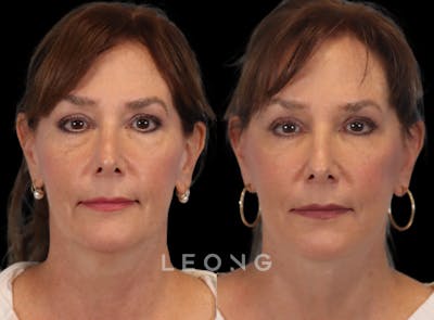 Facelift Before & After Gallery - Patient 767837 - Image 1