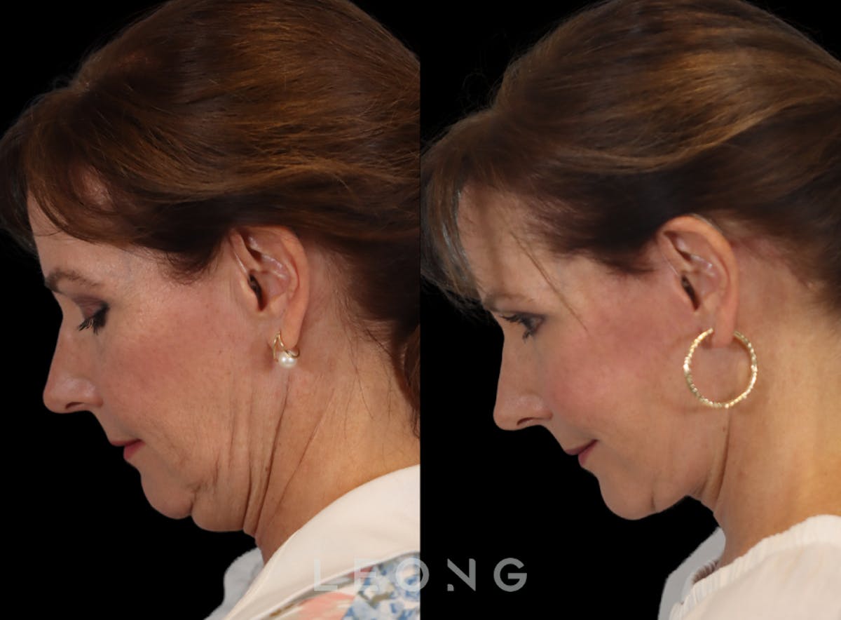 Facelift Before & After Gallery - Patient 767837 - Image 3