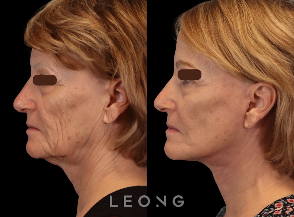 Facelift Before & After Gallery - Patient 205358 - Image 4