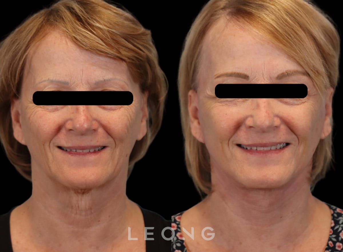 Facelift Before & After Gallery - Patient 205358 - Image 5