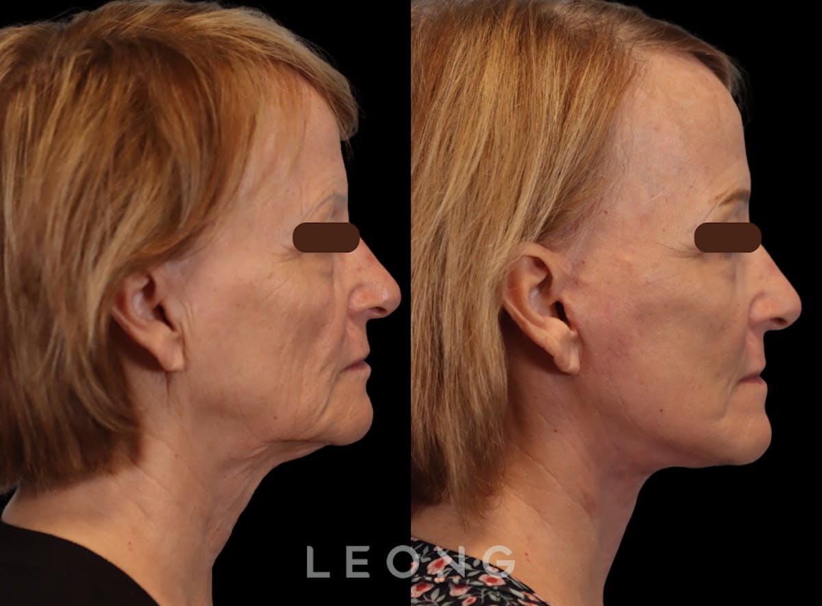 Facelift Before & After Gallery - Patient 205358 - Image 3