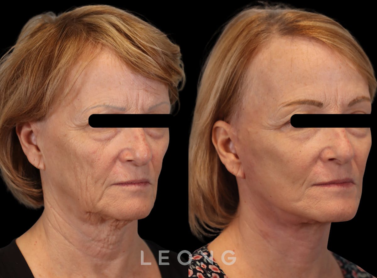 Facelift Before & After Gallery - Patient 205358 - Image 2