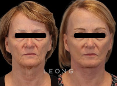 Facelift Before & After Gallery - Patient 205358 - Image 1