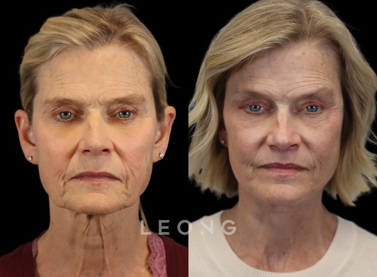 Facelift Before & After Gallery - Patient 376596 - Image 1