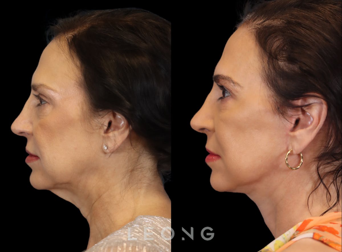 Facelift Before & After Gallery - Patient 235559 - Image 2