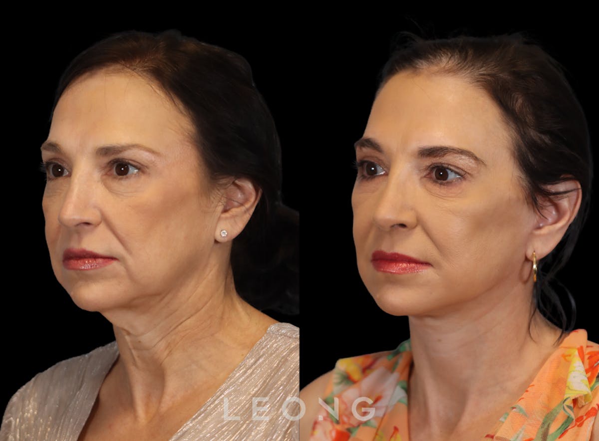 Facelift Before & After Gallery - Patient 235559 - Image 5