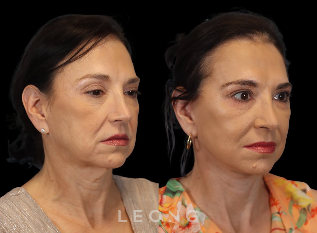 Facelift Before & After Gallery - Patient 235559 - Image 4