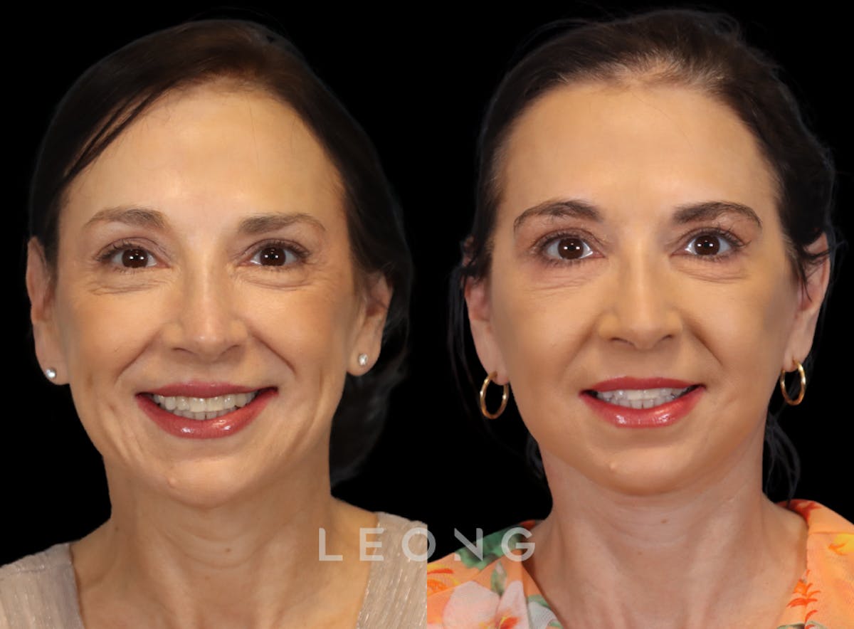 Facelift Before & After Gallery - Patient 235559 - Image 6