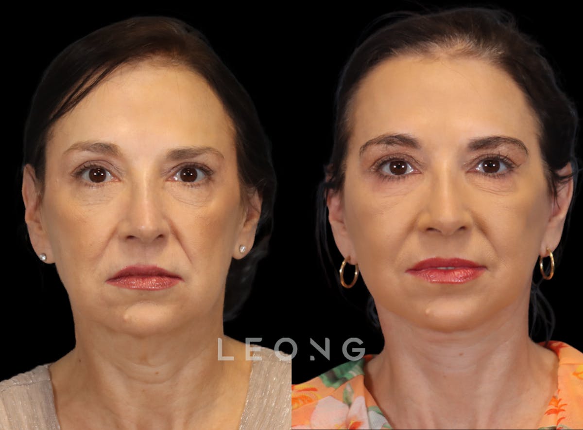 Facelift Before & After Gallery - Patient 235559 - Image 1